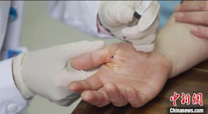 嘉善群眾體驗(yàn)小針刀?！〖紊平y(tǒng)戰(zhàn) 供圖